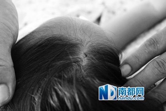 女童頭上被扎的針孔（圓圈處）。賈先生說，被扎不到三秒鐘，女兒就昏了。
