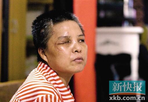 4月初,趙女士遭人搶劫并被打傷,現(xiàn)今右眼失明,頭部被縫100多針。記者 畢志毅/攝
