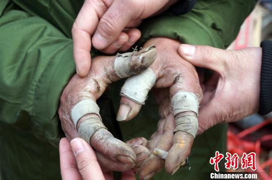 圖為由于常年拾荒，老人雙手布滿傷口。周小云 攝
