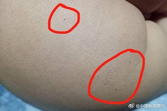 據多名紅黃藍(新天地分園)家長反映，孩子腿部、屁股、腋下出現針眼。