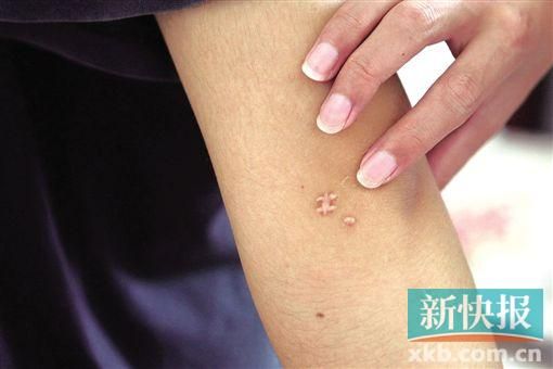 取出針后李星兒手臂留下了傷口。新快報記者 張國鋒/攝
